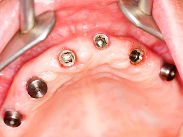 full-arch implantologia dentale torino